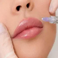 فرصت ویژه تزریق فیلر (فقط ۱ نفر)