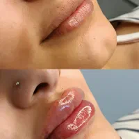 ژل فقط ۸۹۰ * بوتاکس فقط ۷۹۰