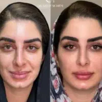 مدل ژل و بوتاکس فوری
