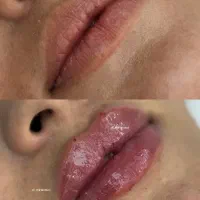تخفیف ویژه و محدود تزریق بوتاکس، فیلر، خال‌برداری
