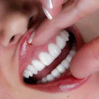 ایمپلنت کامپوزیت لمینت ارتودنسی اقساط