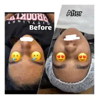 فیشیال و پاکسازی تخصصی پوست نتیجه در یک جلسه