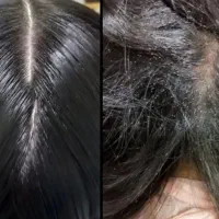 محلول پاکسازی شپش ورشک با ضمانت کتبی و
