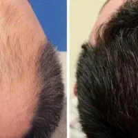 اموزش+استخدام تکنسین کاشت مو