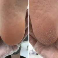 جوراب مخصوص ترک پا
