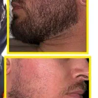 بمب رویش.ریش.زیر30روز