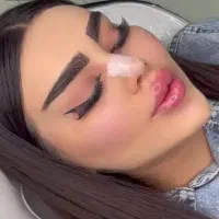 تخفیف ویژه ژل و بوتاکس