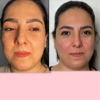 جوانسازی و لیفت صورت با هایفو۳۶ بعدی، مزو،کربوکسی