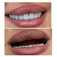 دندانسازی سکندری کرمان دندان ایتالیایی لثه نرم
