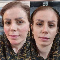 آف ژل و بوتاکس و میکروبلیدینگ
