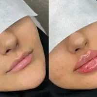 فیلربادی مزوژل فیلر صورت لیفت شقیقه بوتاکس فول فیس