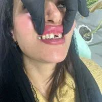 بریچ دندان و کامپوزیت هرفک۸ملیون