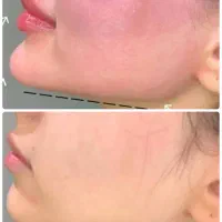 فیلر بوتاکس