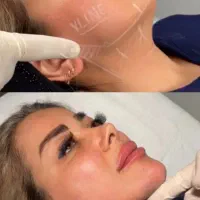 پیکرتراشی،لیپو،ابدو