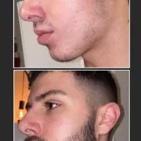 رفع کم پشتی ریش اقایان