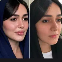 ژل۵۹۰و بوتاکس۳۹۰و نخ۸۰۰در کلینک معتبر