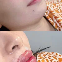 تزریق ژل و بوتاکس