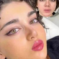 فیلر لب و فول فیس ( ژل ) لیزر