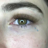 کاشت هیدن(کاشت بدون آسیب)
