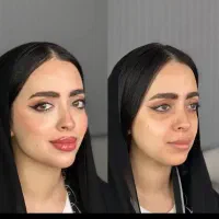ژل لب فیلربوتاکس کلینیک زیبایی لیزر هایفو بلفارو|خدمات آرایشگری و زیبایی|مشهد, شریف|دیوار