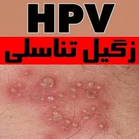 مشاوره Hpv/ درمان زگیل تناسلی