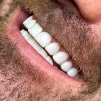 دندانپزشکی/کامپوزیت دندان/ریمو/تخصصی