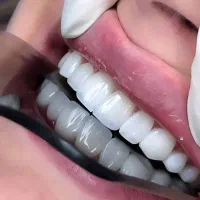 ایمپلنت کامپوزیت لمینت در اقساط ویژه