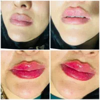 فیلرلب چابهار