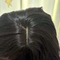 پوستیژ مو ، پروتز مو