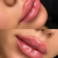 آفر طلایی تزریق ژل، بوتاکس و آنزیم