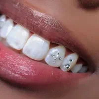 نگین دندان توسط دندانپزشک