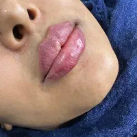 افر ویژه فیلر ژل بوتاکس ژل لب مزو صورت و مو پرسینگ