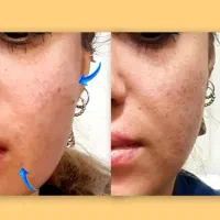 تزریق بوتاکس و فیلر طبیعی(مشاوره رایگان)