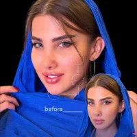 تخفیف فیلر بوتاکس مزو نخ با ۸۰ درصد به مدت محدود