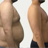 پکیج‌های ویژه جراحی زیبایی بدن با تخفیف ماه محرم
