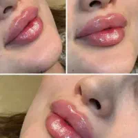 تزریق تخصصی ژل در صدرا