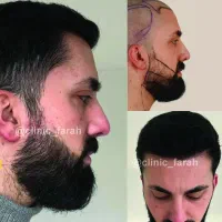 کاشت مو وبلفارو دکتر آل قیس بالای 18 سال سابقه