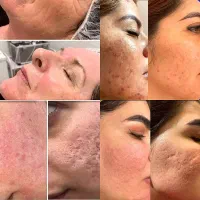 تخفیفات پی ار پی،بوتاکس،مزوتراپی،فیلر،prpتوسط پزشک