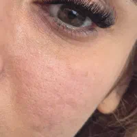 کاشت مژه موقت با ماندگاری بالا