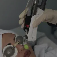 حذف دائمی موهای زائد با لیزر شاتی ۲۰۲۵
