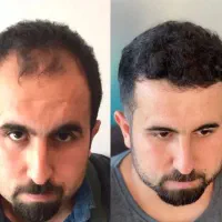 جشنواره تابستانی آموزش کاشت مو وابرو