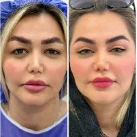 جراحی پلک(بلفاروپلاستی) فقط با ۱۰۹۰۰