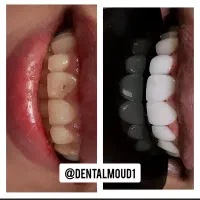 ایمپلنت،کامپوزیت،جرمگیری
