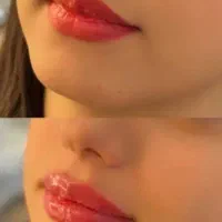 تزریق ژل و بوتاکس