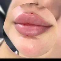 تزریق تخصصی ژل و بوتاکس