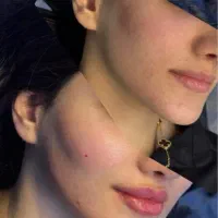 فیلر بوتاکس پی آر پی با تخفیف ویژه 50درصدی
