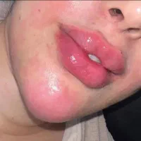 تزریق بوتاکس ژل لب چونه کانتورینگ صورت جام جم