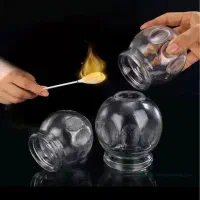 حجامت و بادکش گرم