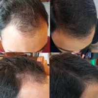 رویش و پرپشتی ریش