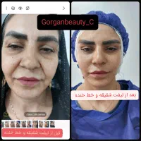 مینی لیفت صورت ـ لیفت شقیقه تیپ پلاستی نوک بینی